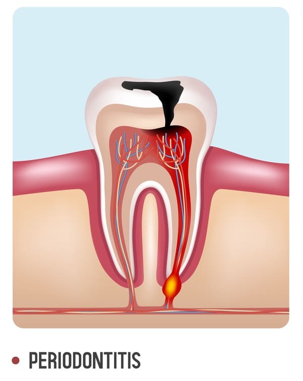 Лечение периодонтита